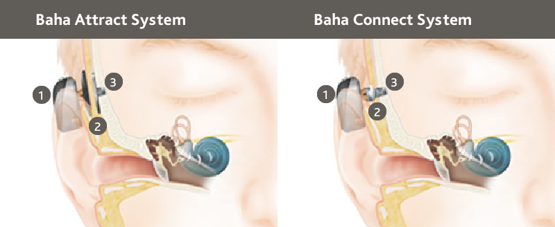 Soluciones quirúrgicas: Baha® Attract y Baha® Connect