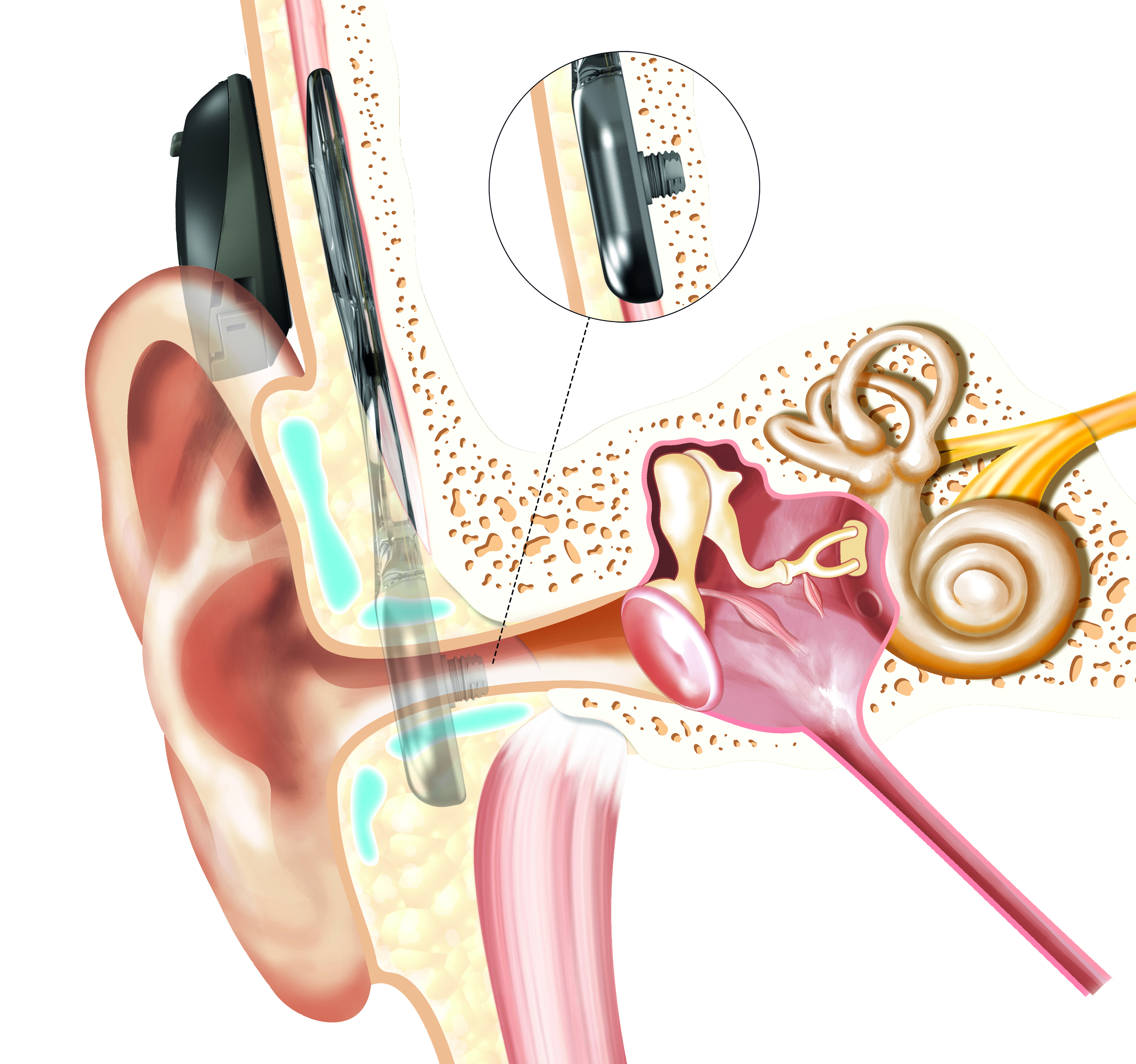 Sistema Osia Cochlear