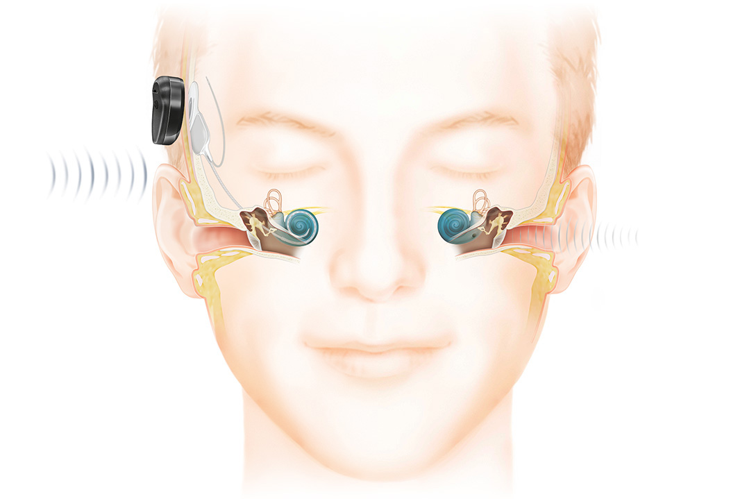 Processar de som Cochlear Kanso 2 e implante coclear.